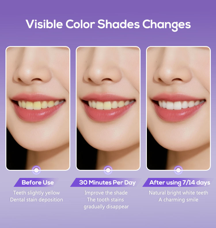 Glorysmile V34 Teeth Whitening Strips - Purple Correction Technology with PAP+